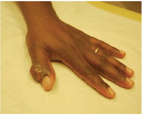 The figure shows a lesion caused by orf virus infection of a thumb cut with a knife while slaughtering a lamb as part of Easter festivities in Massachusetts during 2011. At an infectious diseases clinic, the lesion was examined and noted to be 2 × 2 × 2 cm and firm, without discoloration, puru¬lent discharge, fluctuance, or bleeding. The lesion was removed surgically and the wound was healing.